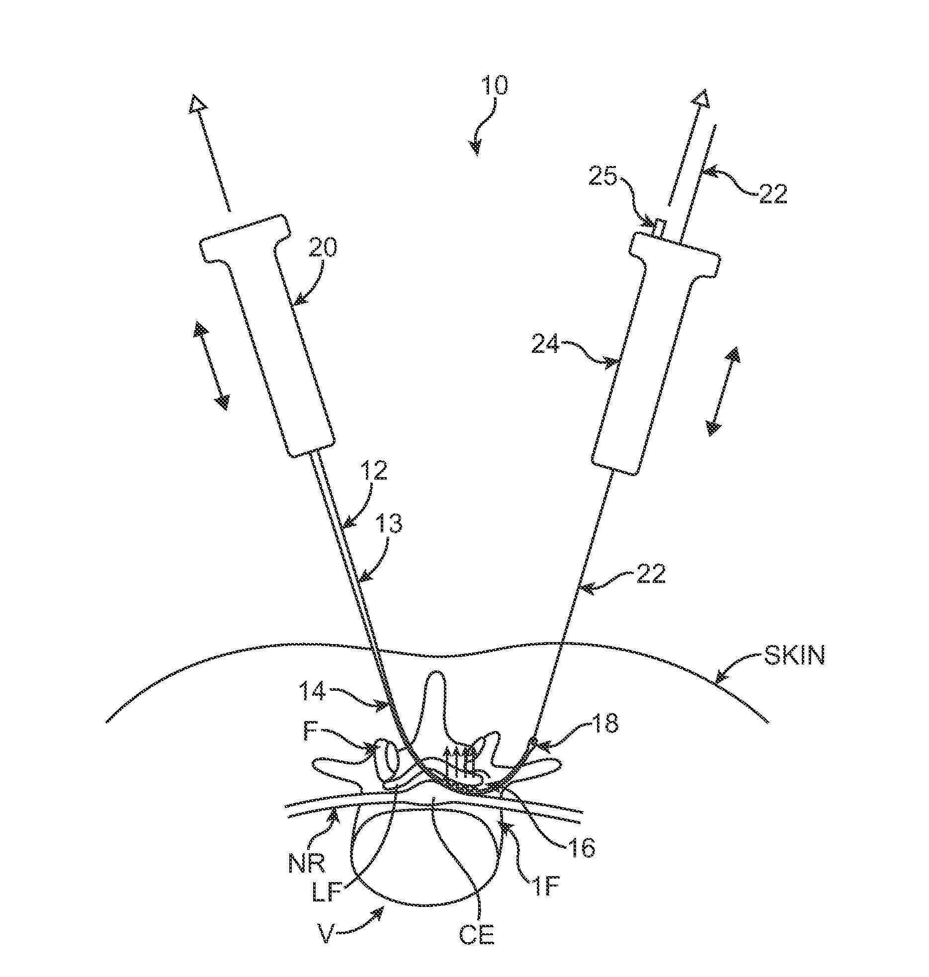 Methods, systems and devices for carpal tunnel release