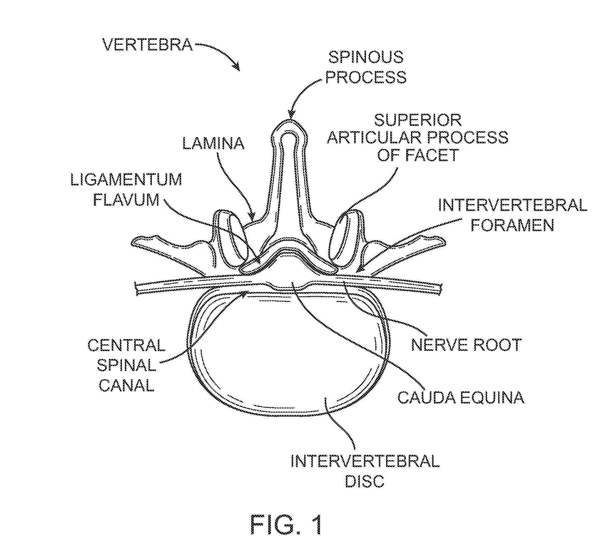 Methods, systems and devices for carpal tunnel release