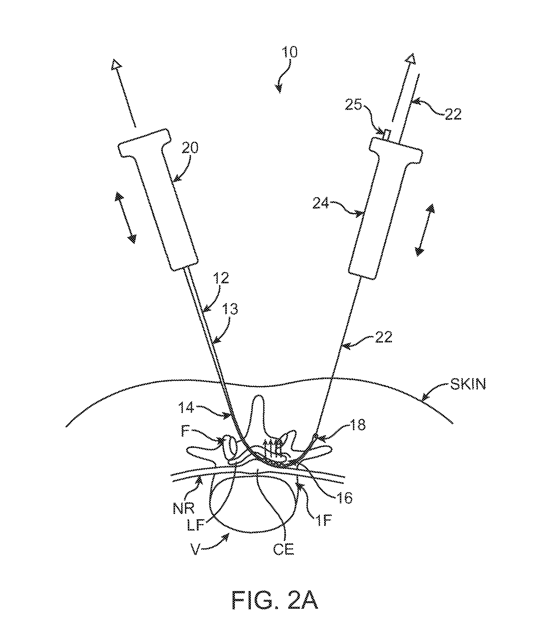 Methods, systems and devices for carpal tunnel release