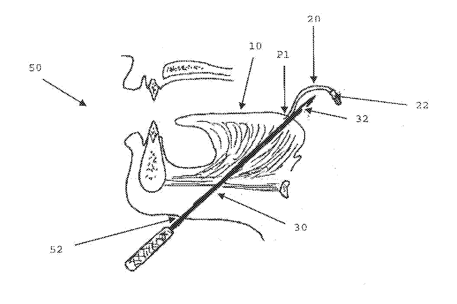 Modular Tissue Securement Systems