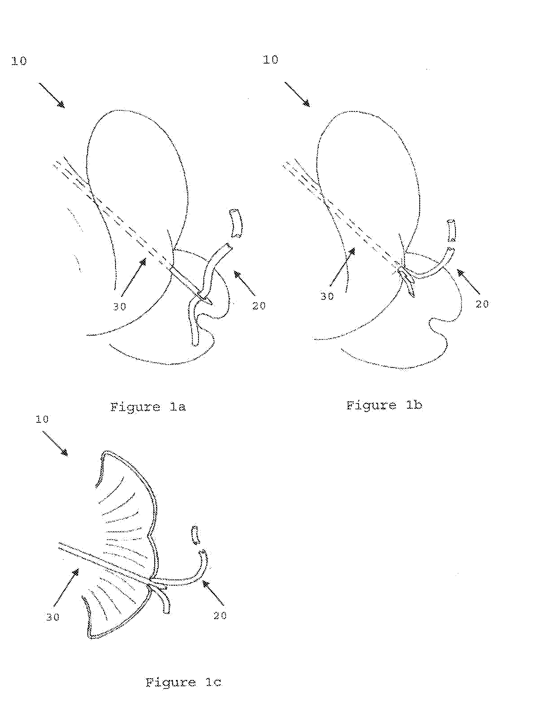 Modular Tissue Securement Systems