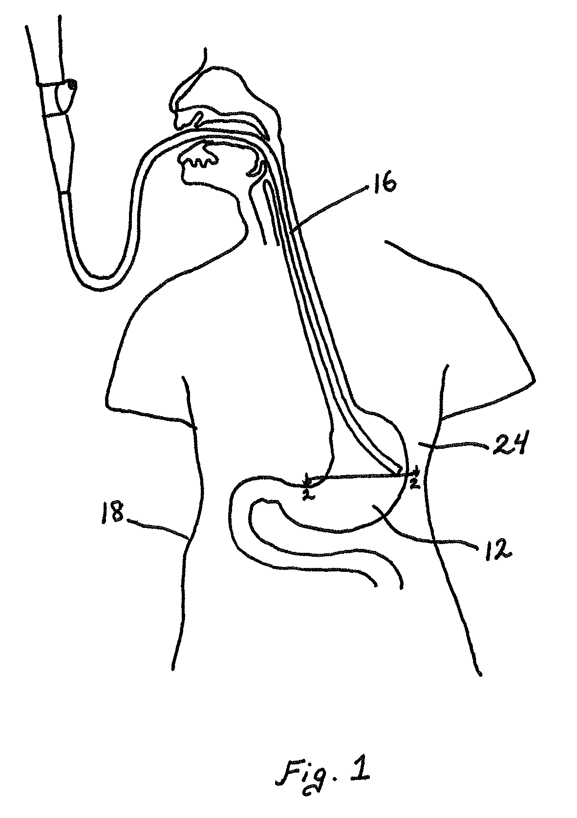 Gastric volume reduction using anterior to posterior wall junctions