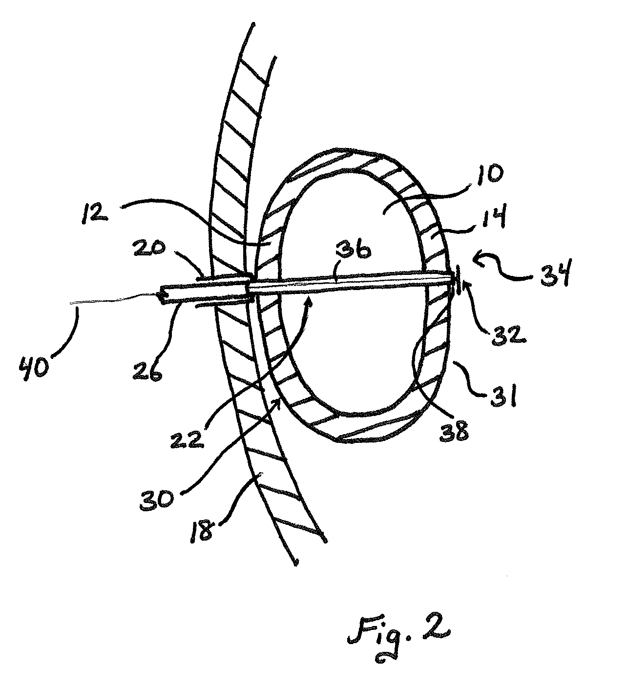 Gastric volume reduction using anterior to posterior wall junctions