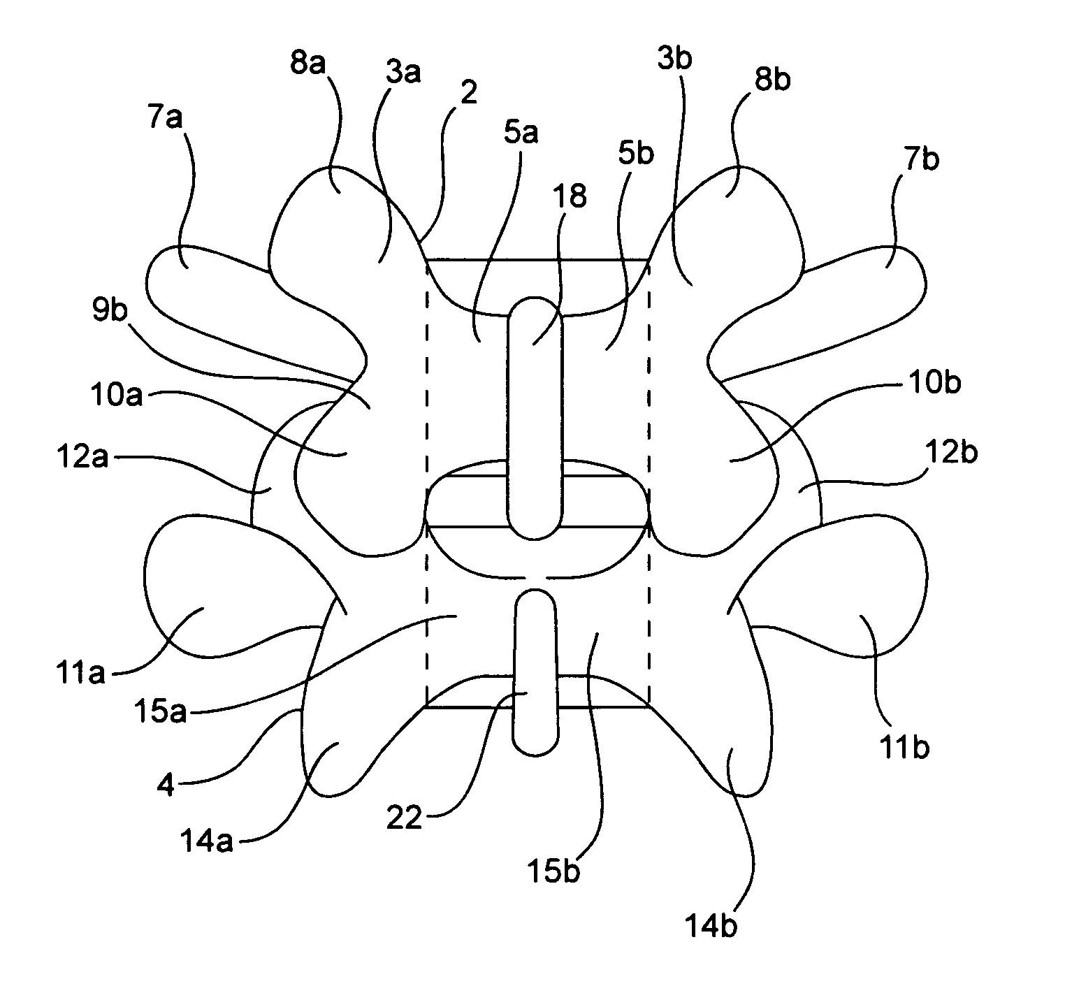 Systems and methods for posterior dynamic stabilization of the spine