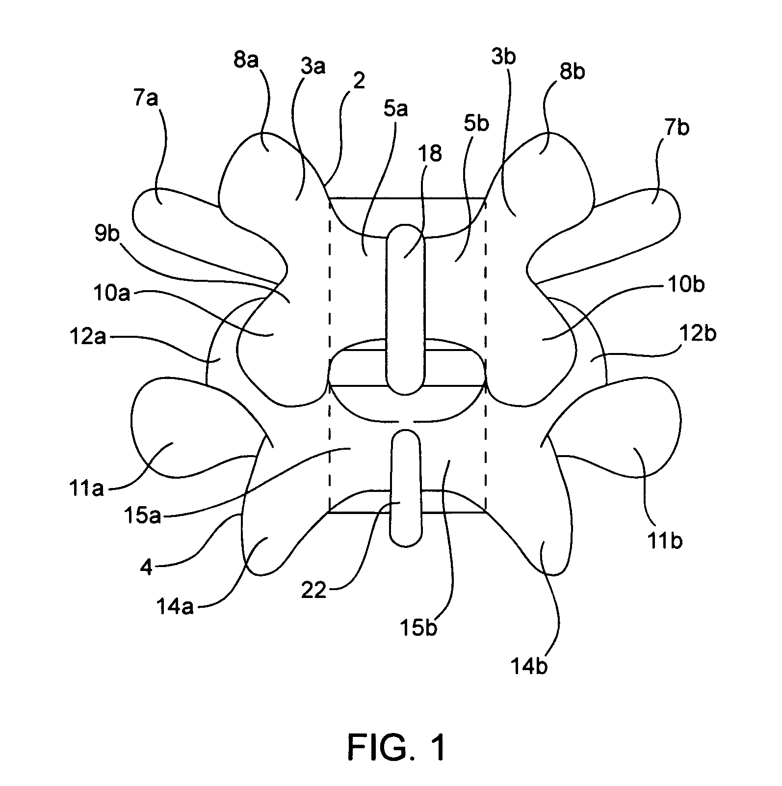 Systems and methods for posterior dynamic stabilization of the spine