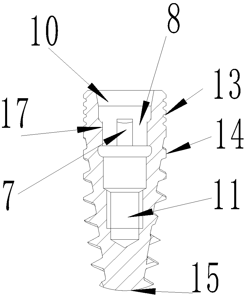 Implant with bone absorption resistance