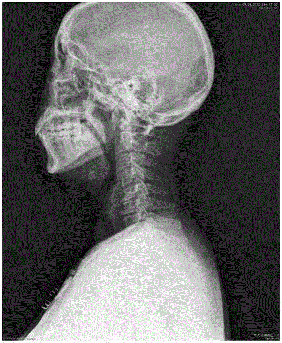 Cervical traction device that returns to the physiological radian of the cervical spine