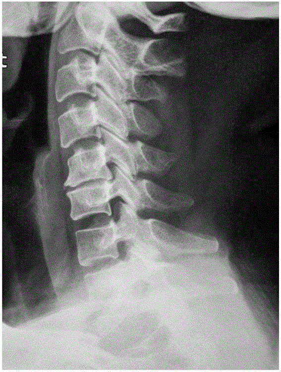 Cervical traction device that returns to the physiological radian of the cervical spine