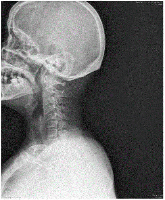 Cervical traction device that returns to the physiological radian of the cervical spine