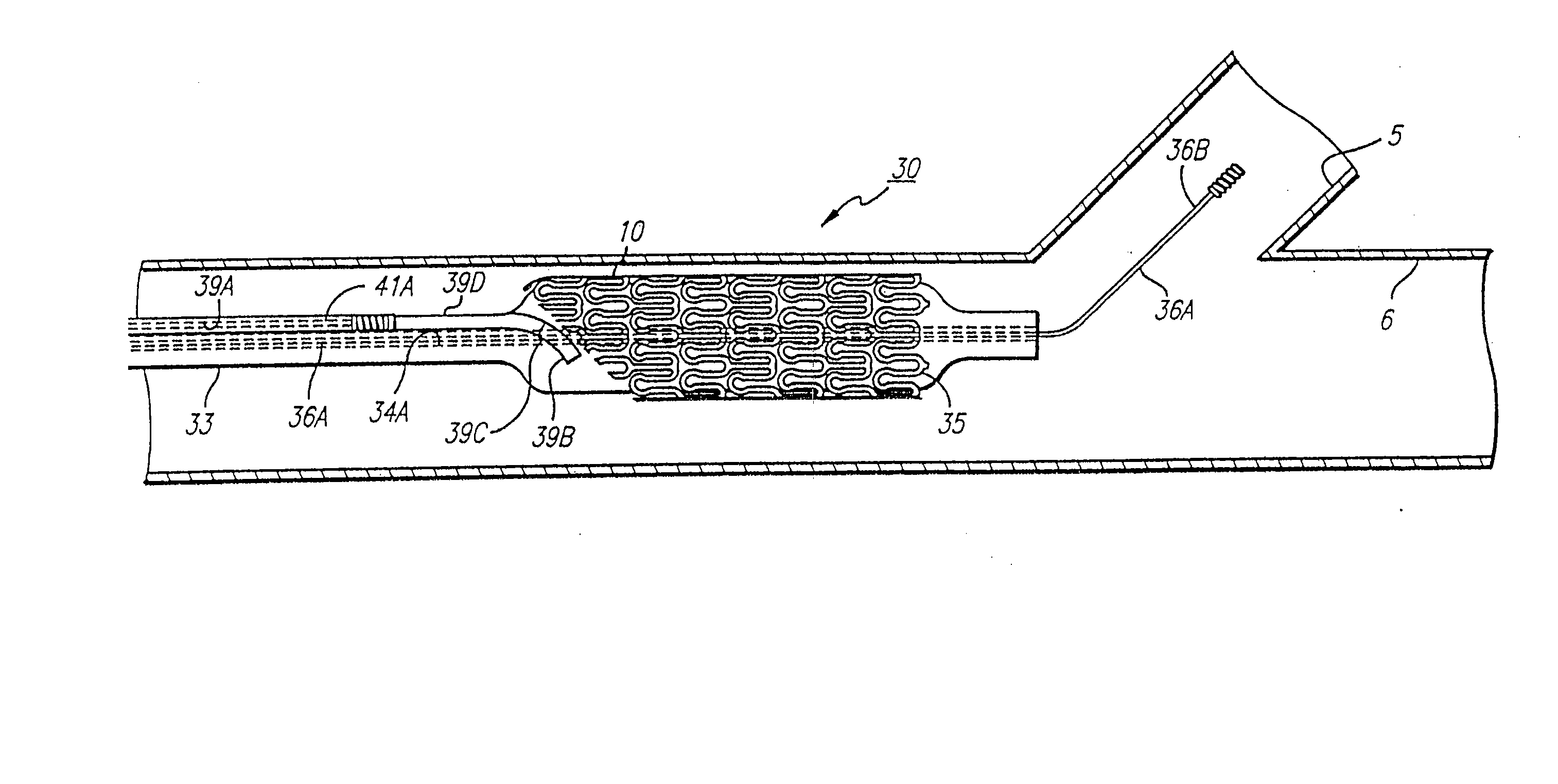 Stent and catheter assembly and method for treating bifurcations