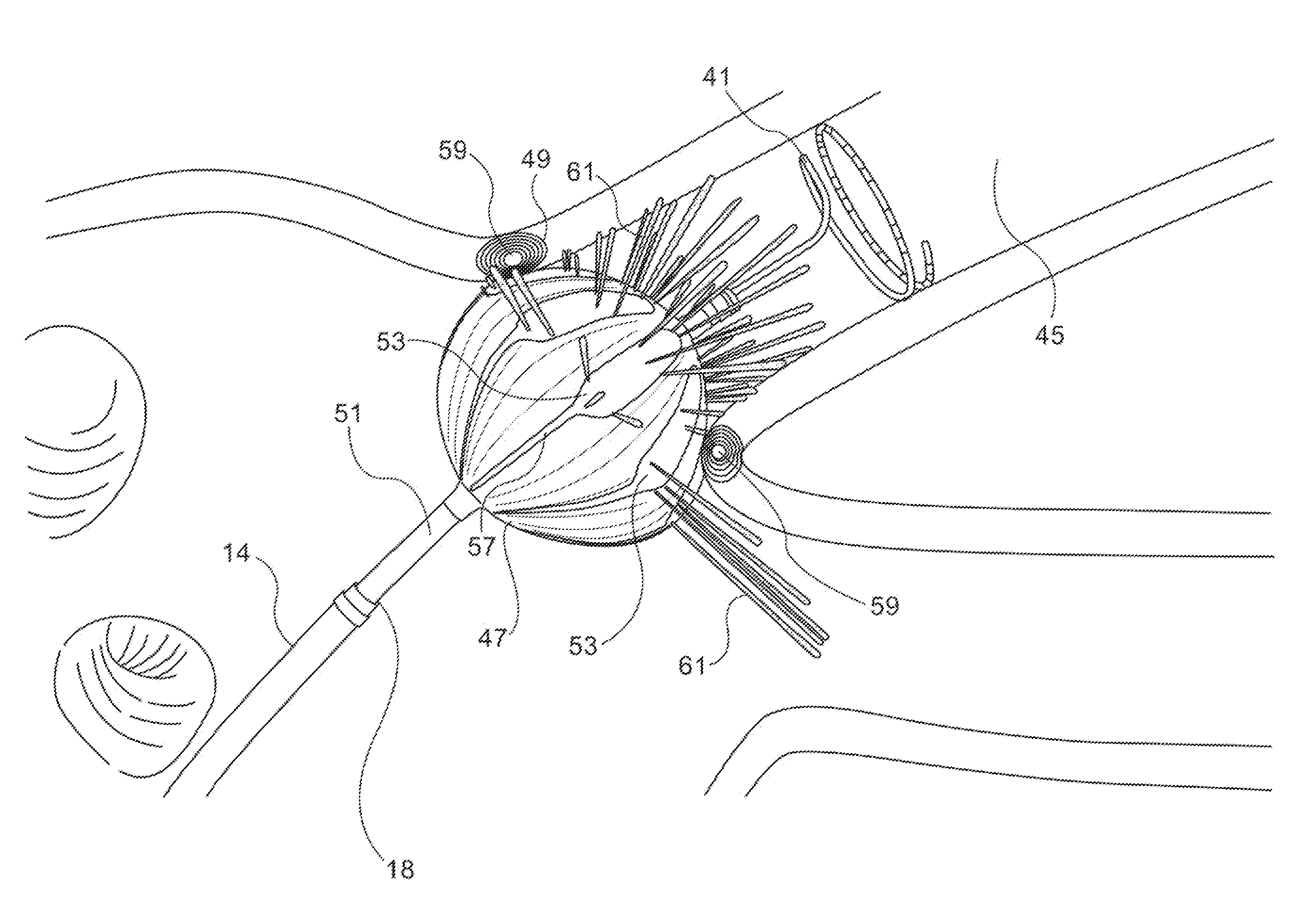 Balloon for ablation around pulmonary veins