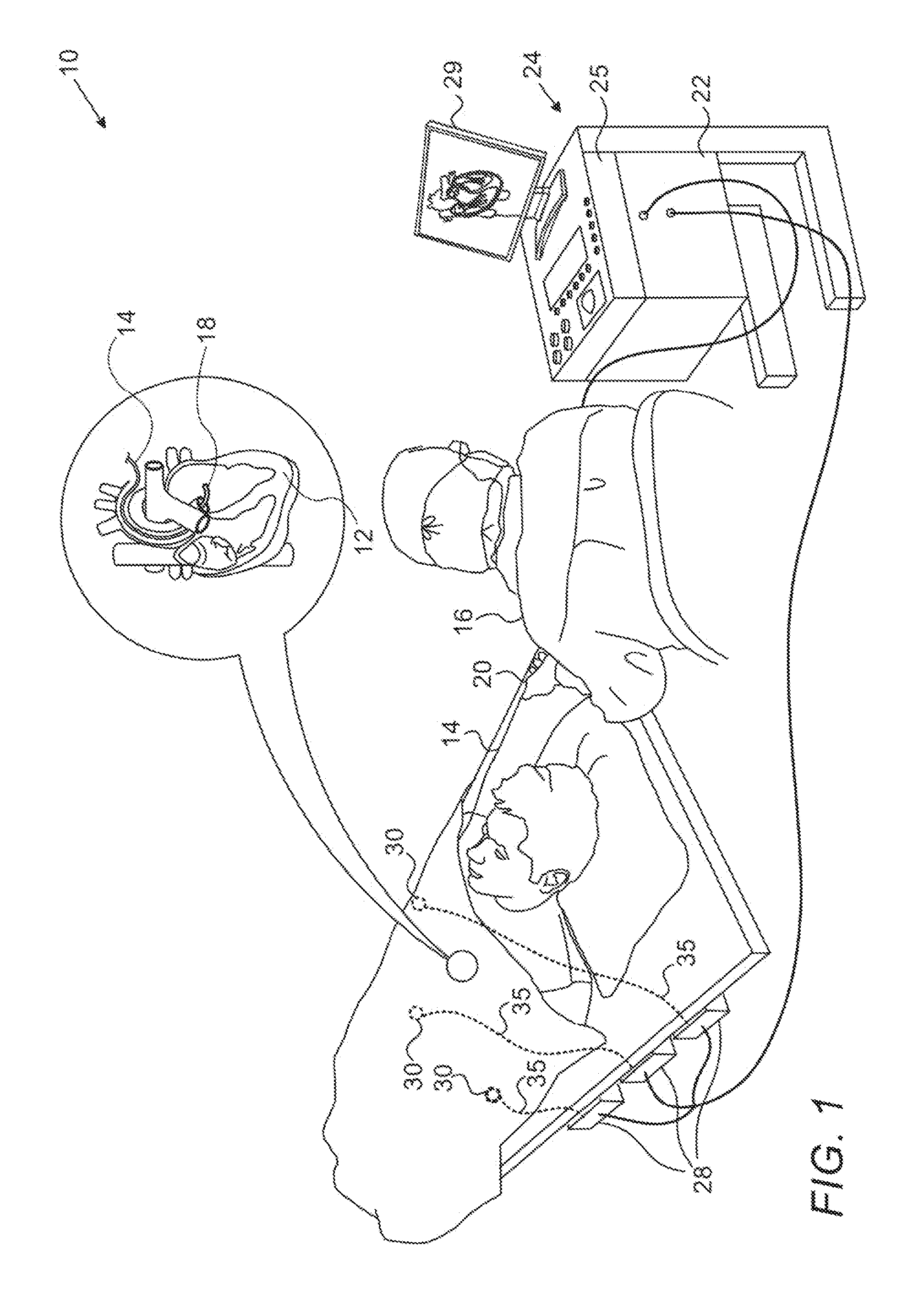 Balloon for ablation around pulmonary veins