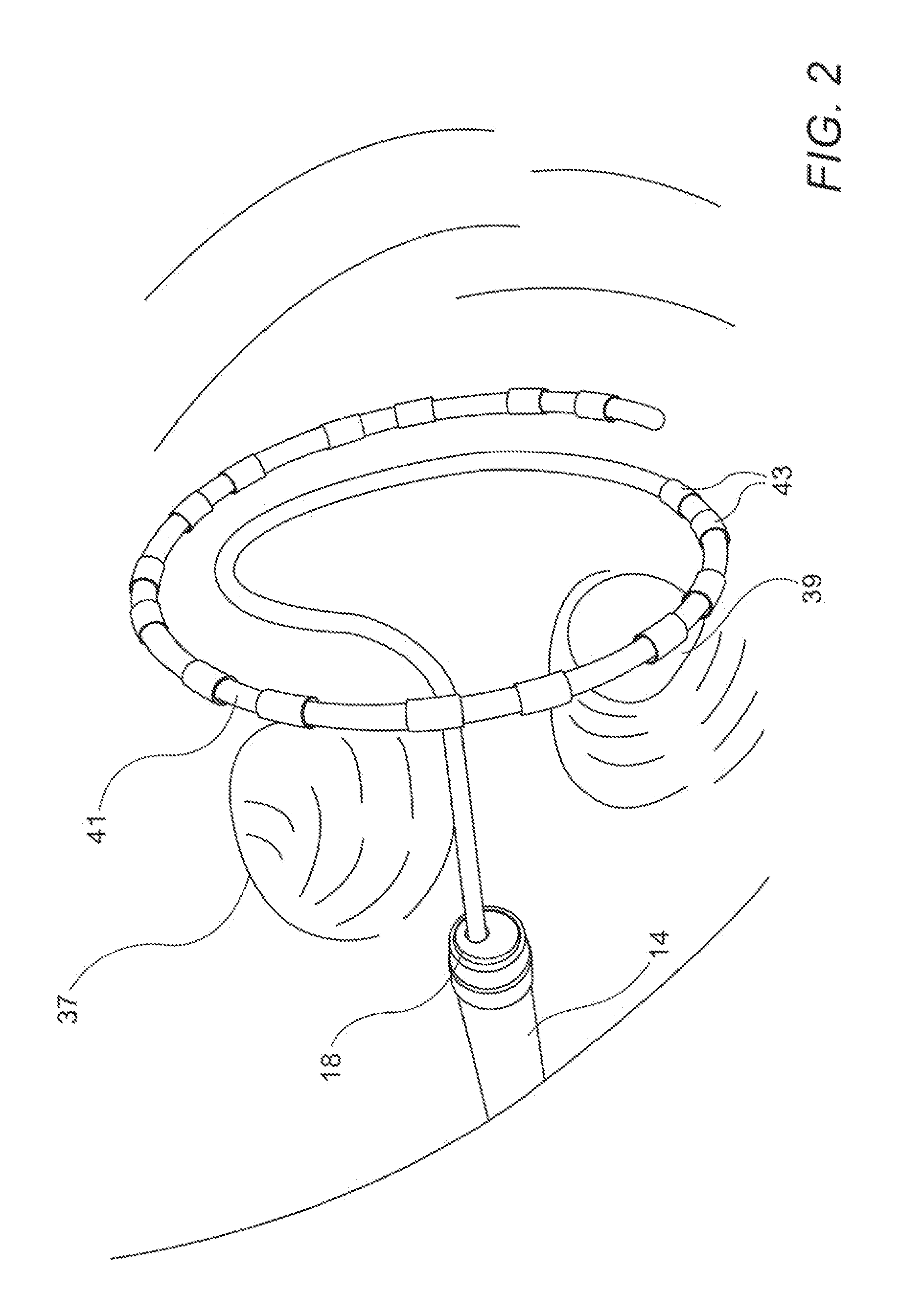 Balloon for ablation around pulmonary veins