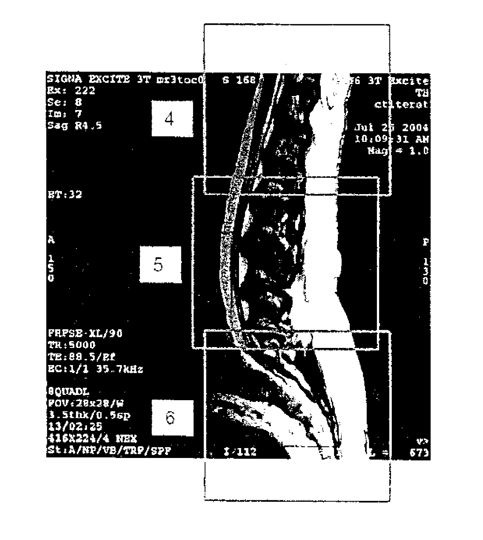 Mr spectroscopy system and method for diagnosing painful and non-painful intervertebral discs