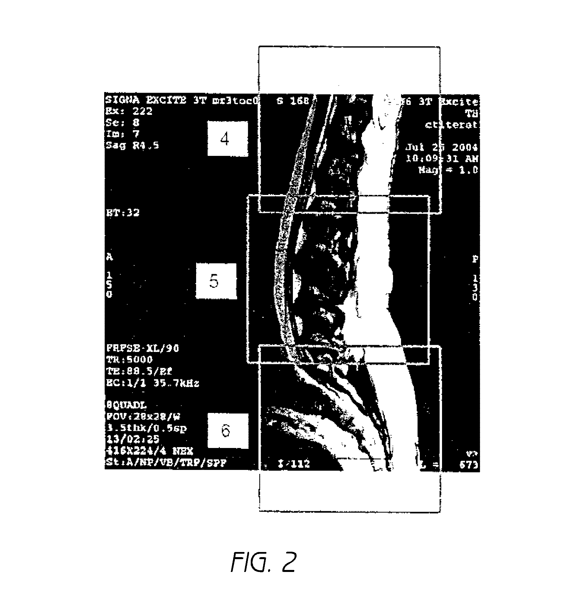 Mr spectroscopy system and method for diagnosing painful and non-painful intervertebral discs