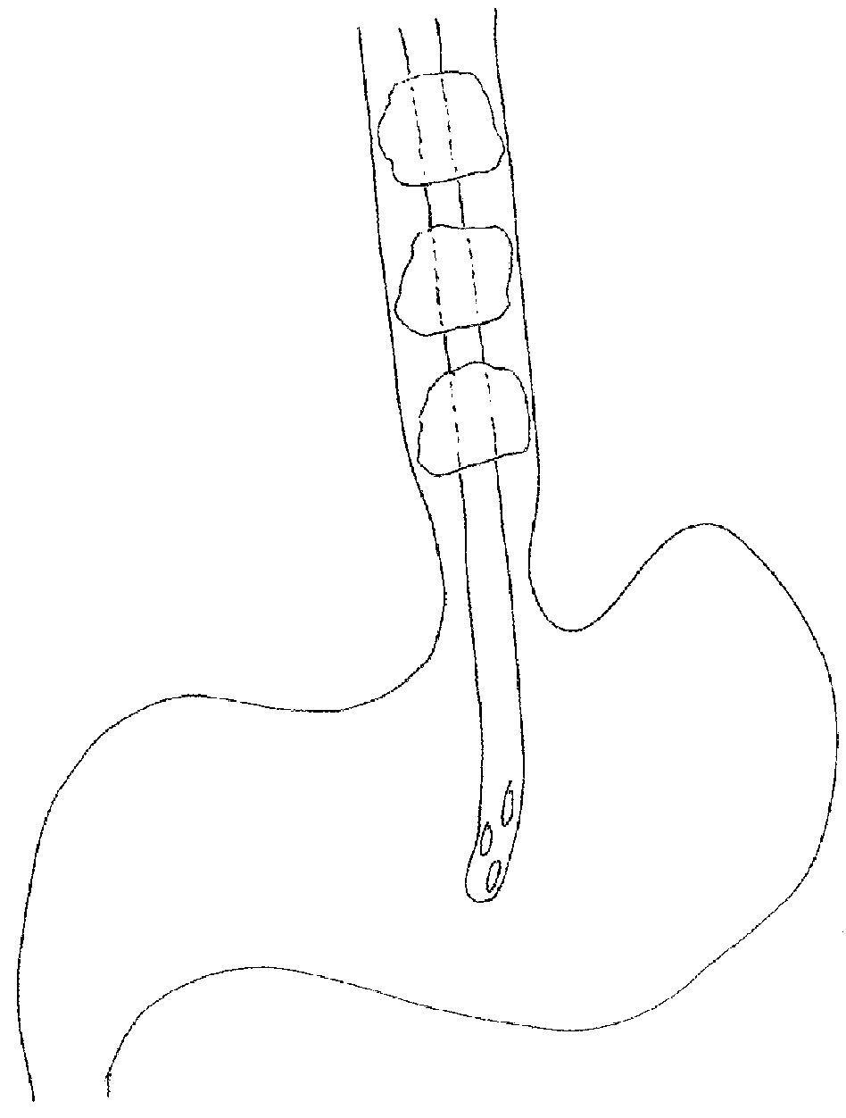 Method and device of detecting and/or blocking reflux