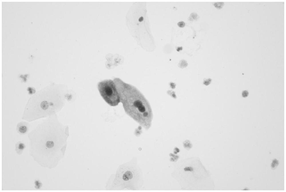 Immune cell chemical labeling chromogenic kit for auxiliary diagnosis of cervical cancer