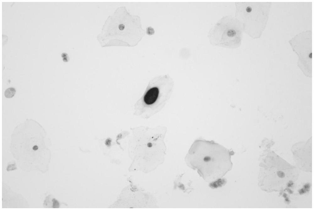 Immune cell chemical labeling chromogenic kit for auxiliary diagnosis of cervical cancer