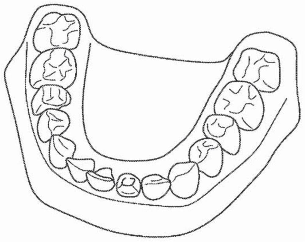 Virtual model of articulation derived from intraoral scans