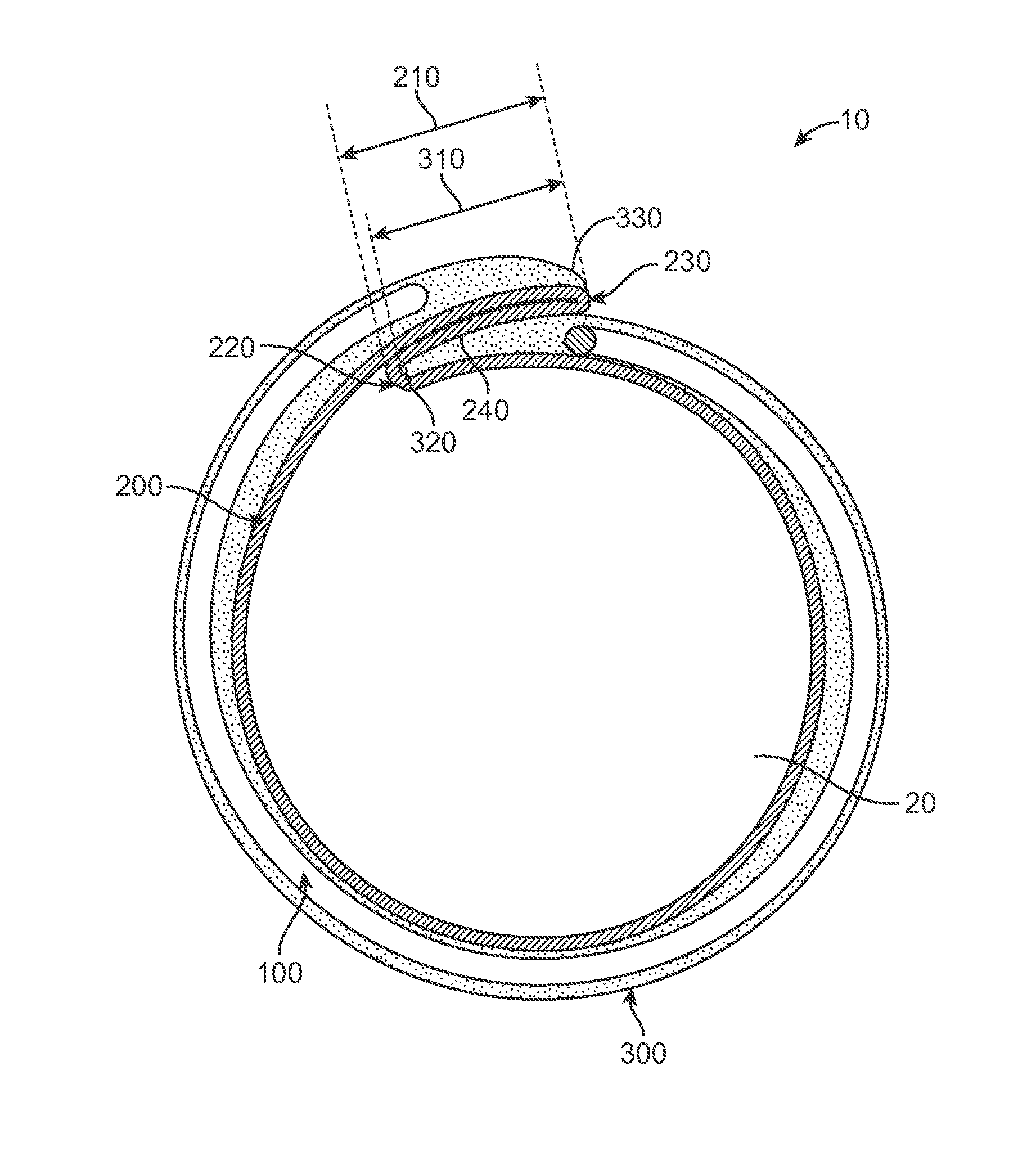 Elastic Introducer Sheath