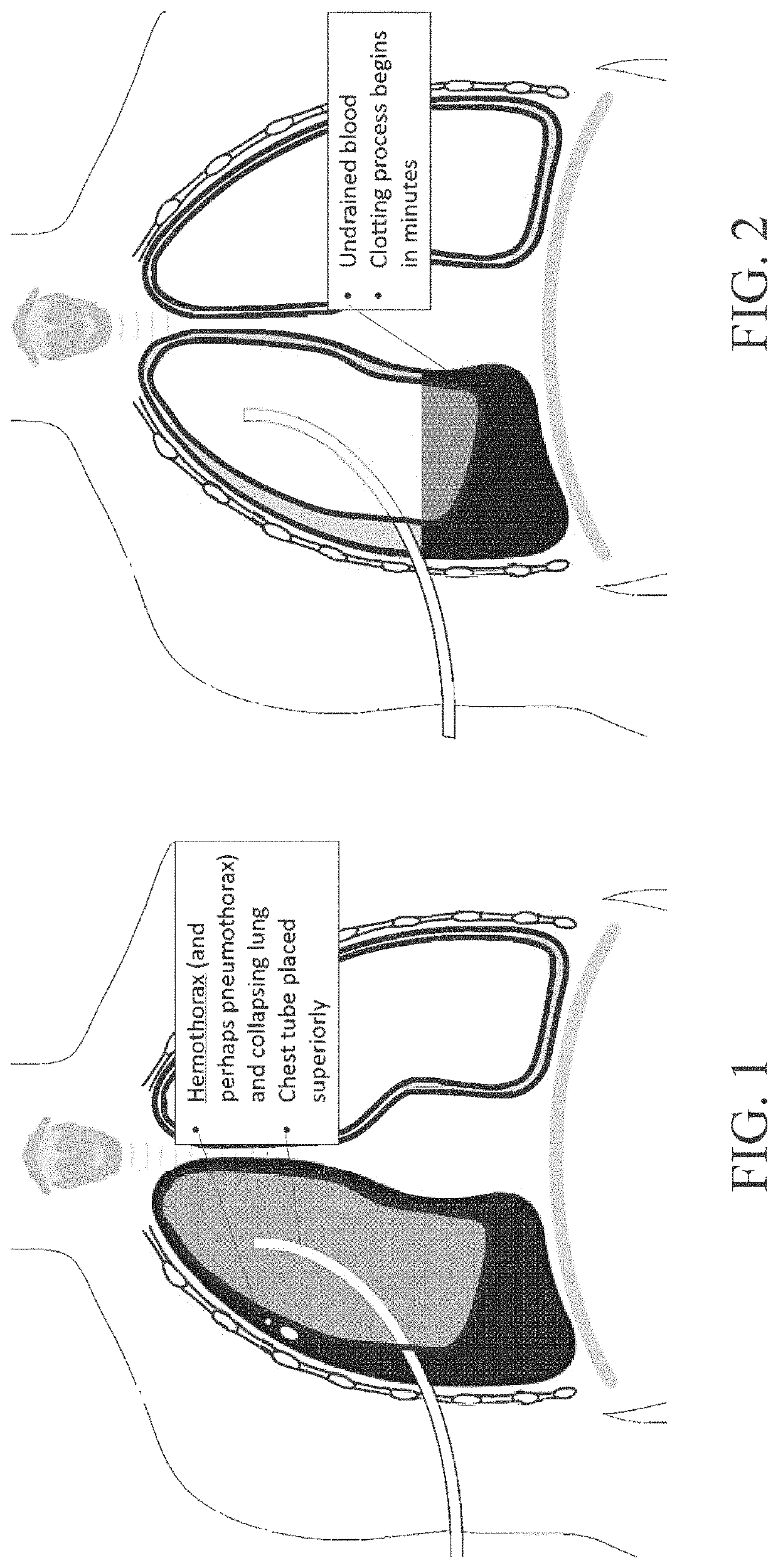 System for improving fluid drainage