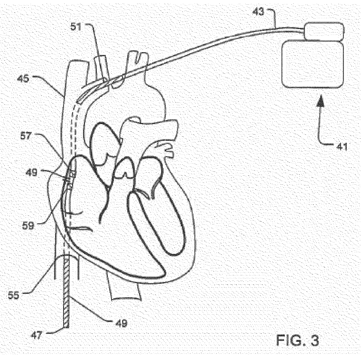 System and method for extra cardiac defibrillation