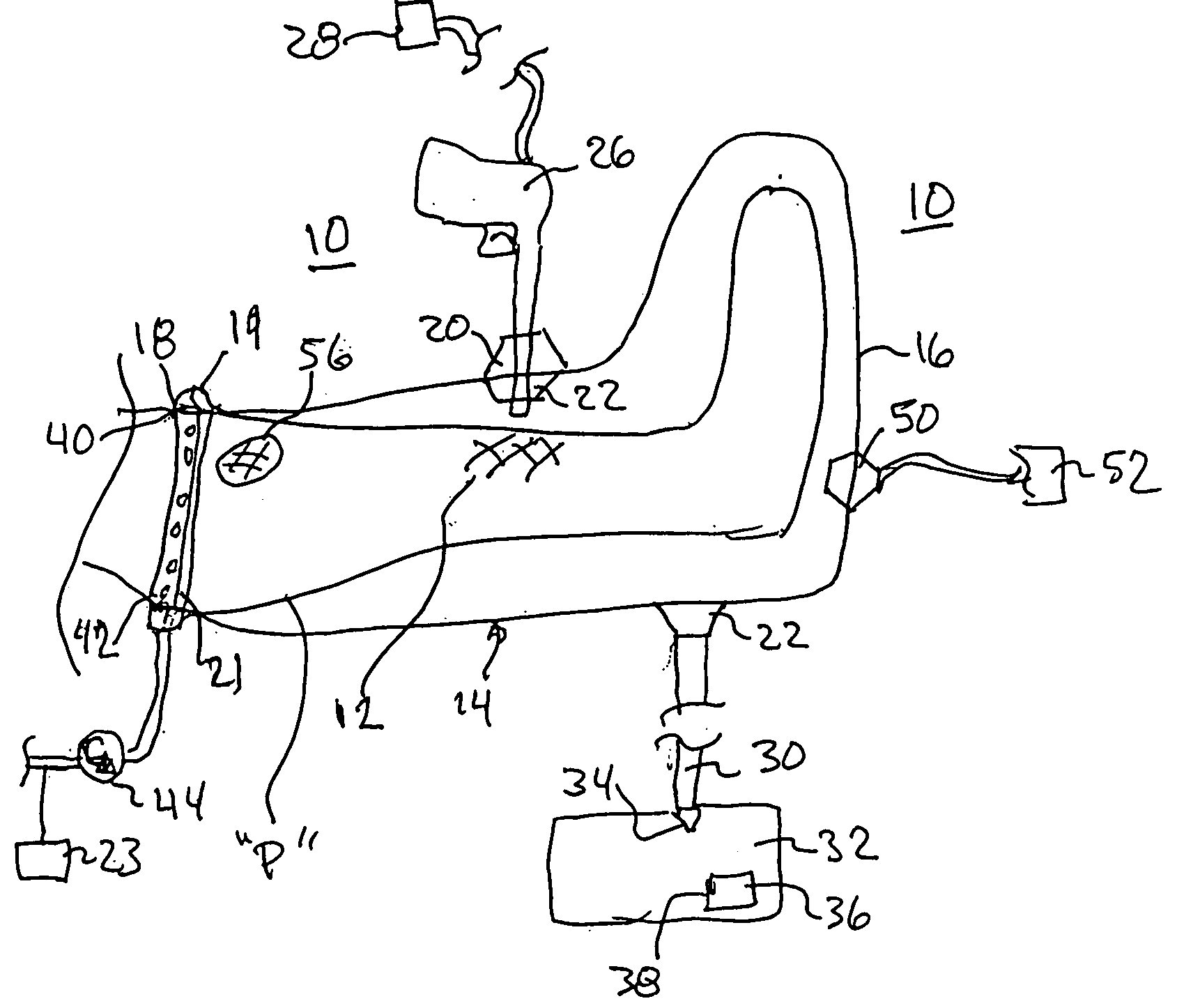 Wound irrigation containment arrangement