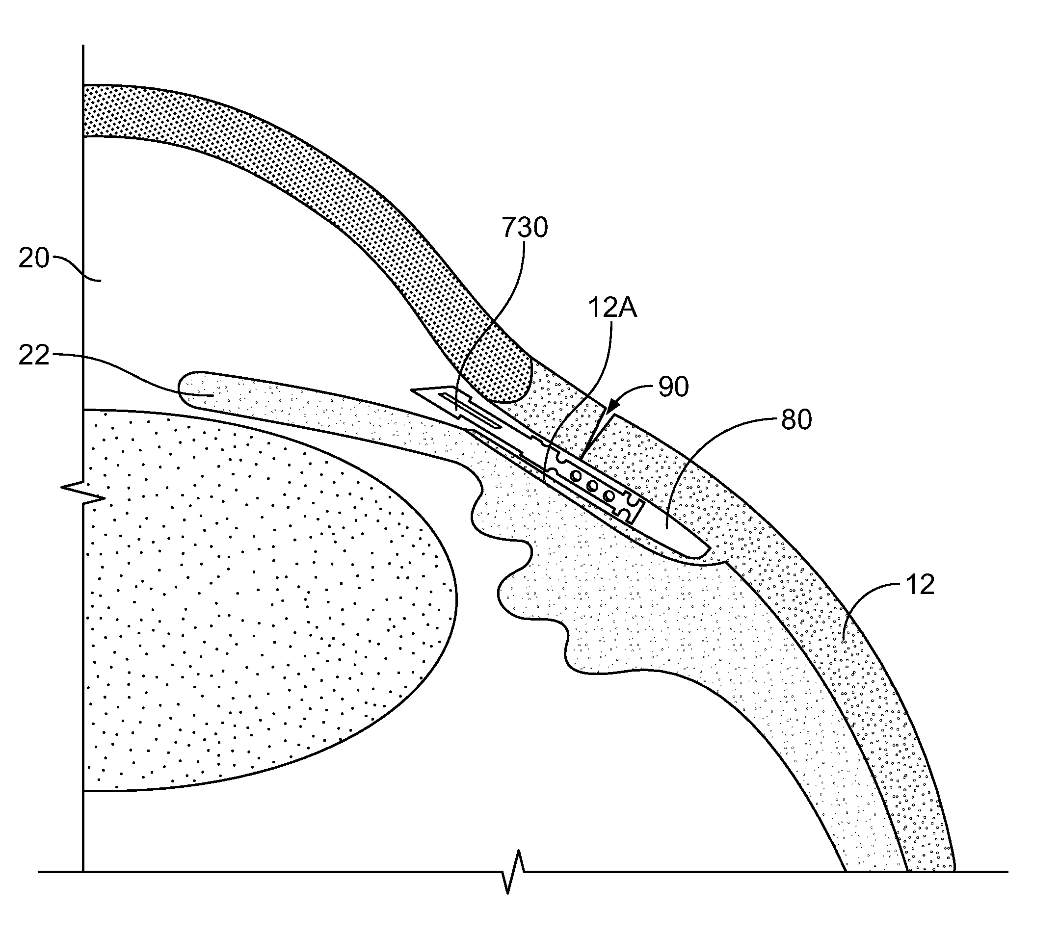 Fluid drainage device, delivery device, and associated methods of use and manufacture