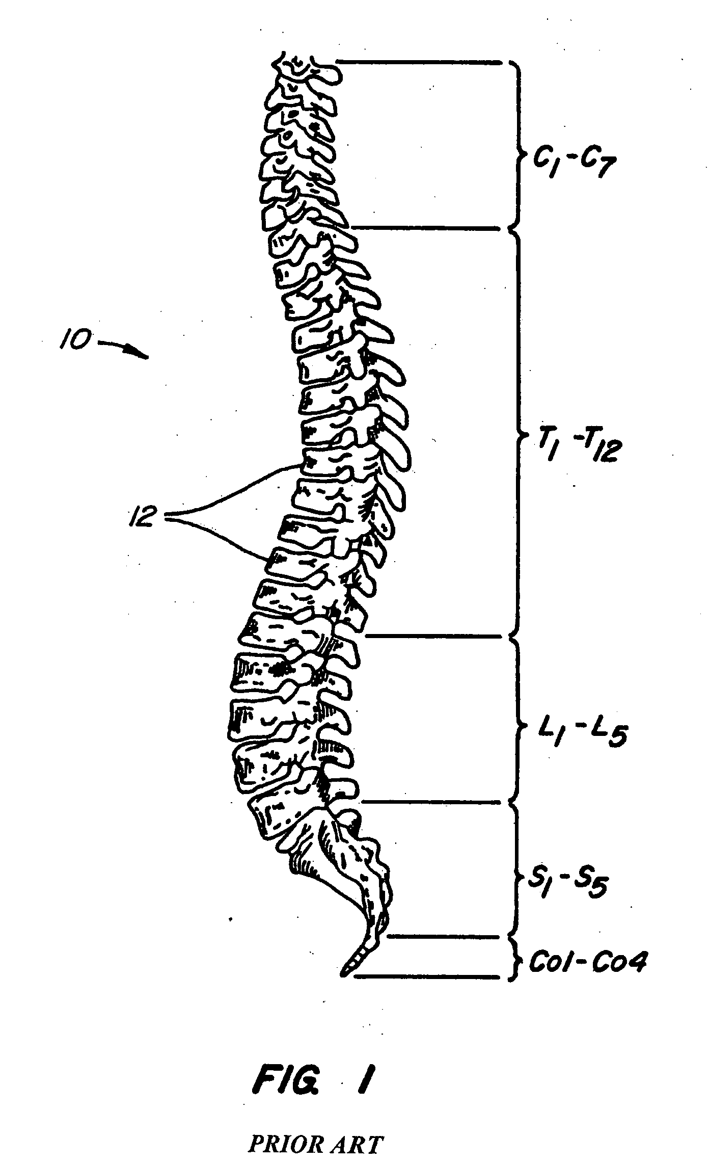 Implantable spinal device revision system
