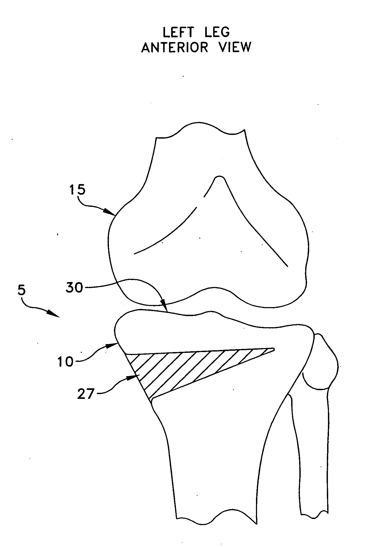 Method and apparatus for performing an open wedge, high tibial osteotomy