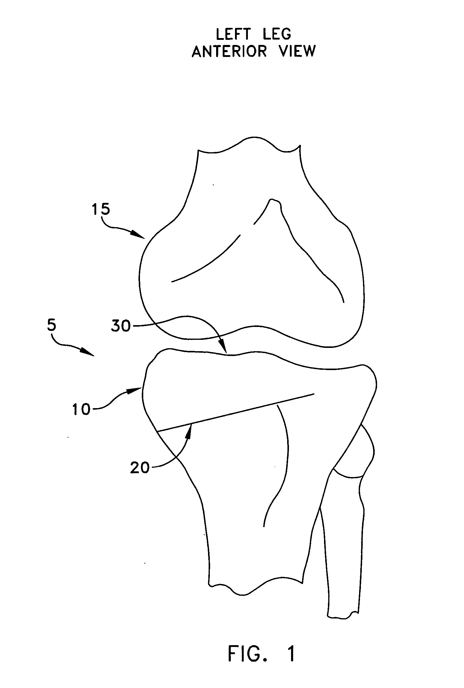 Method and apparatus for performing an open wedge, high tibial osteotomy