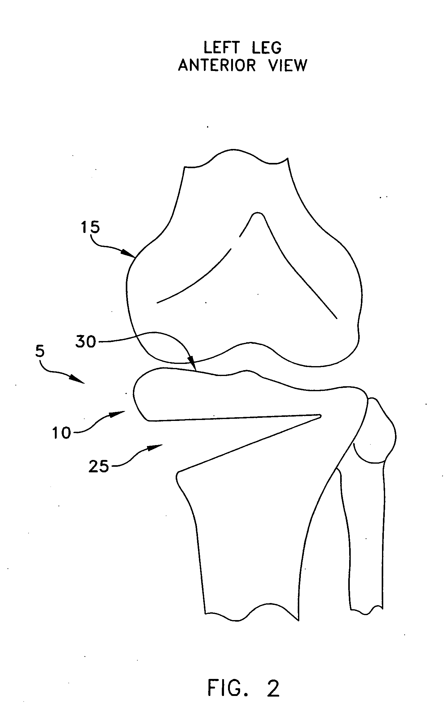 Method and apparatus for performing an open wedge, high tibial osteotomy