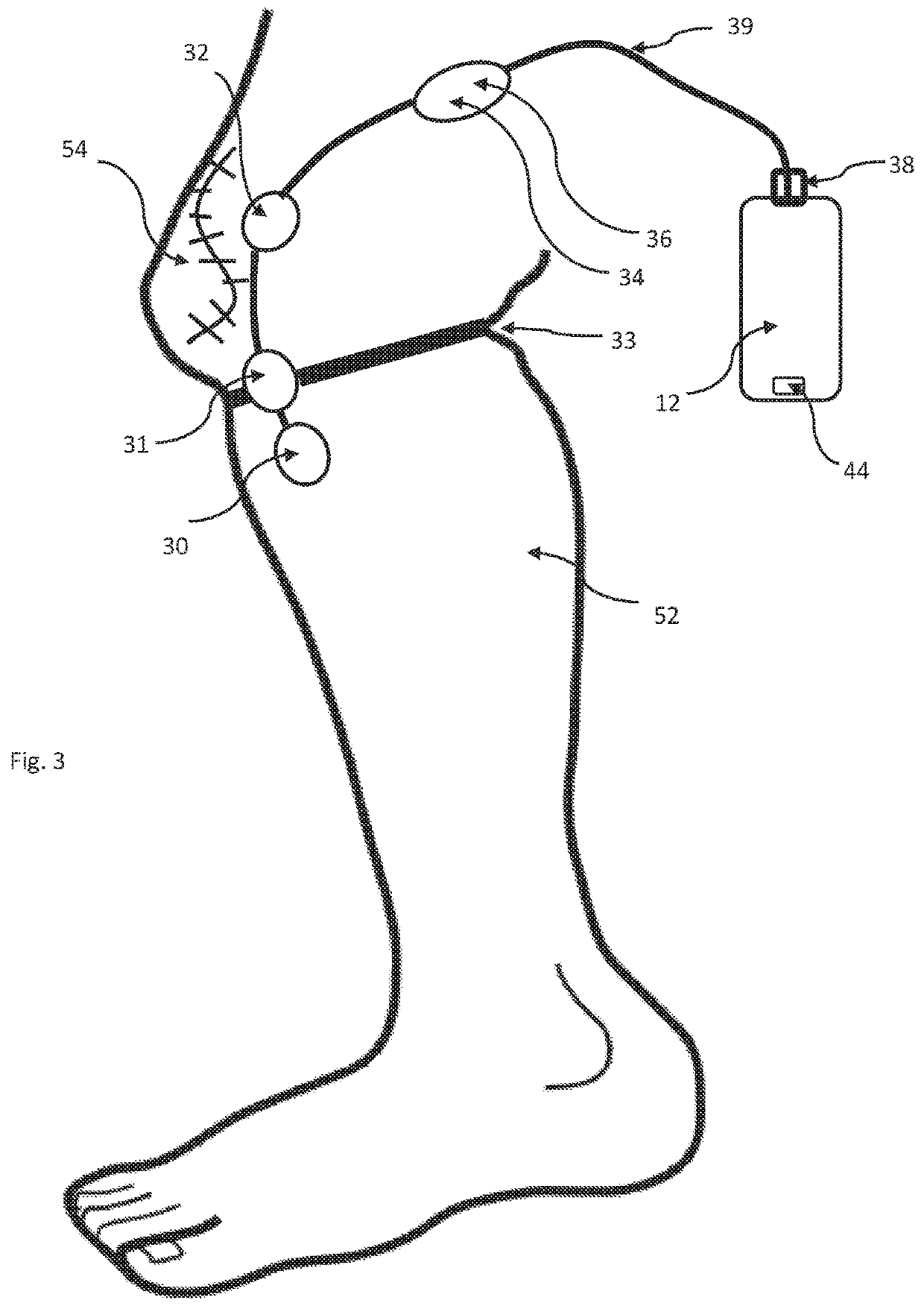 Method for Calibrating Apparatus for Monitoring Rehabilitation from Joint Surgery