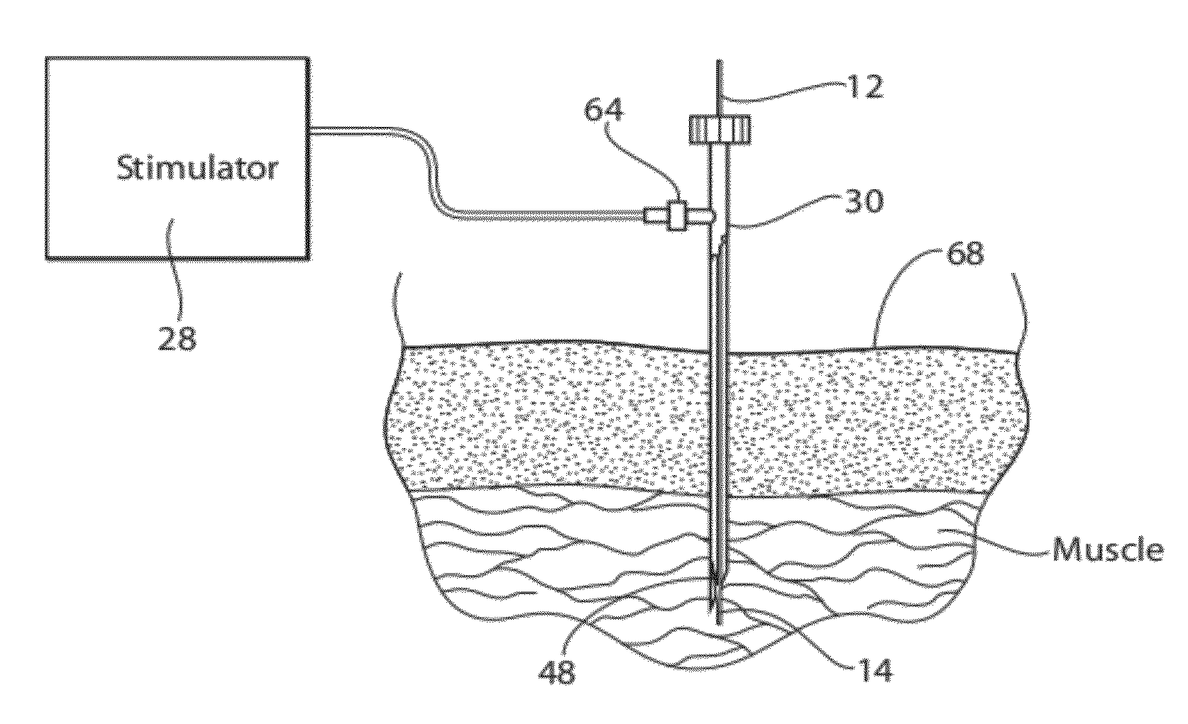 Systems and methods to place one or more leads in tissue to electrically stimulate nerves to treat pain