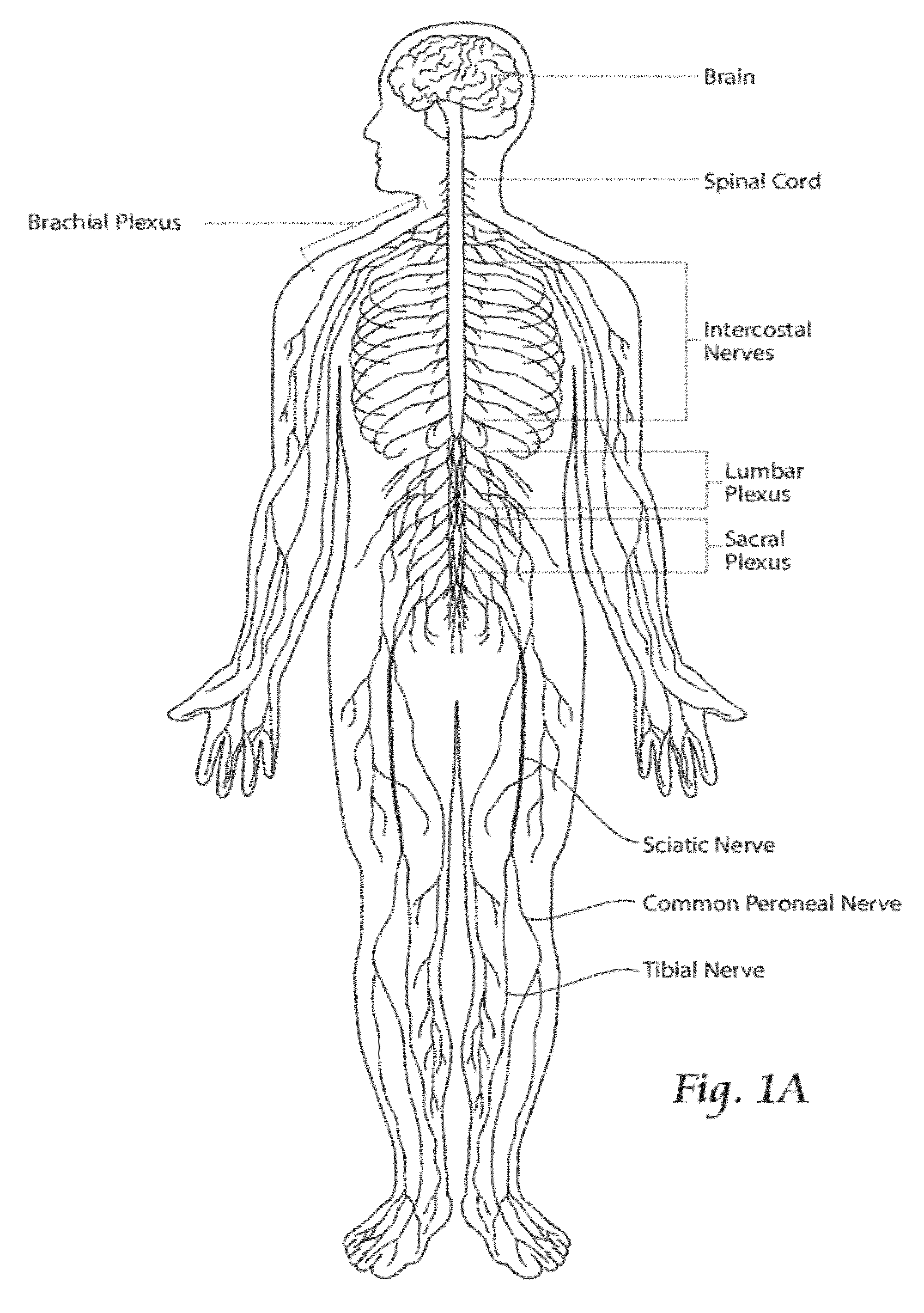 Systems and methods to place one or more leads in tissue to electrically stimulate nerves to treat pain