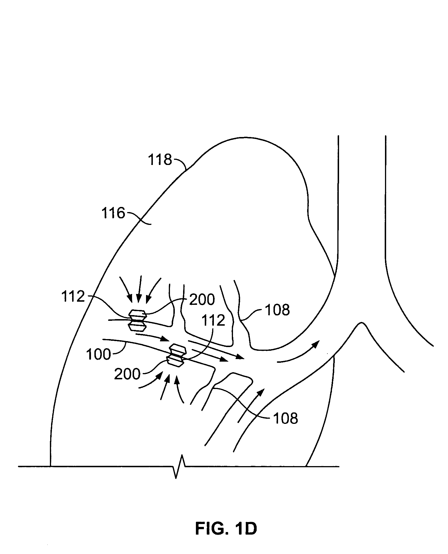 Methods and devices for maintaining patency of surgically created channels in a body organ