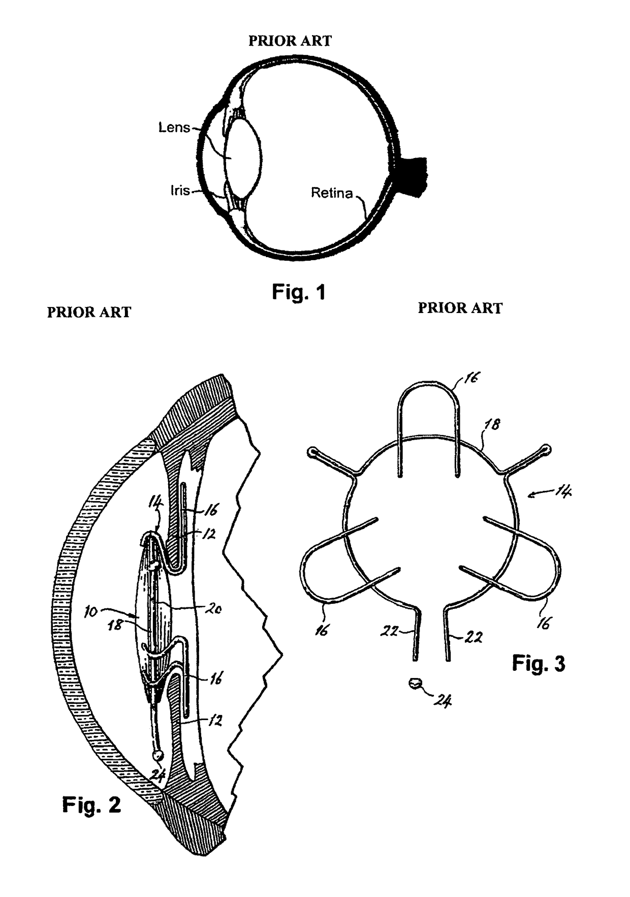 Intraocular implant