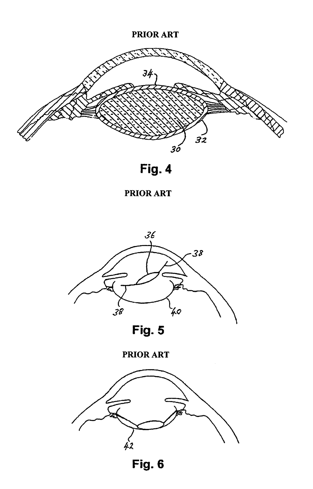 Intraocular implant