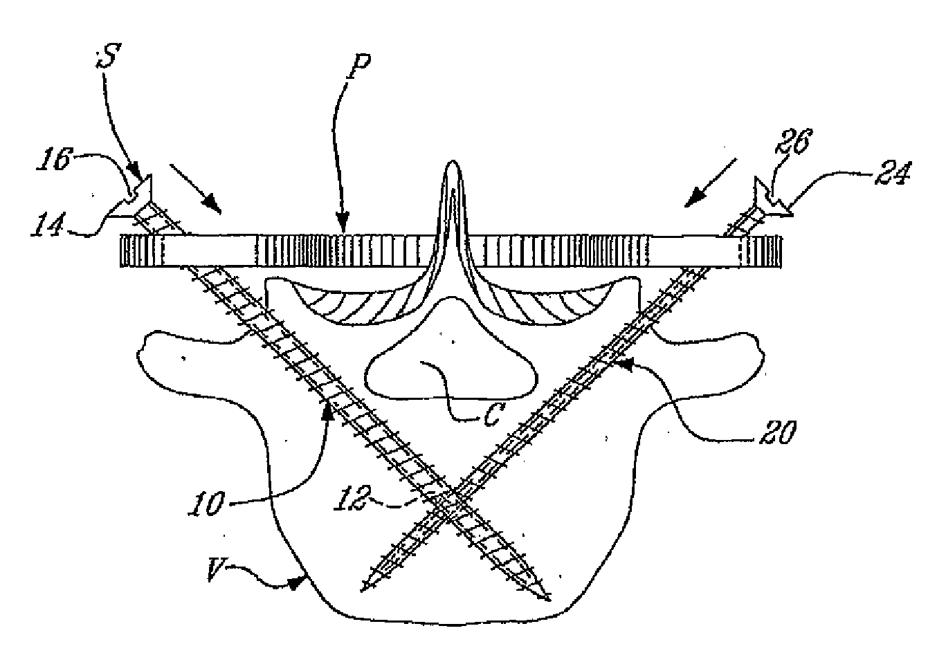 Anchoring System for Fixing Objects to Bones