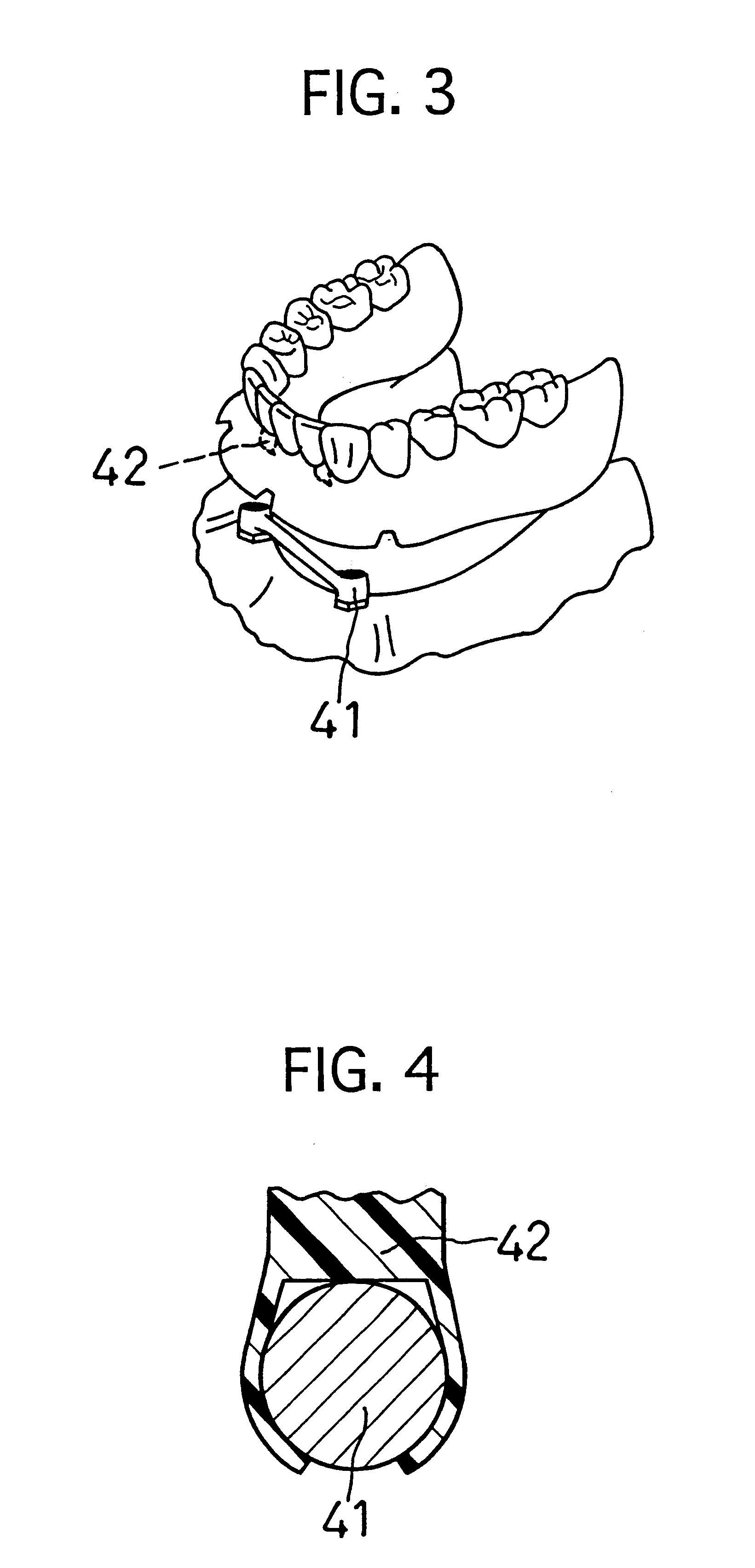 Dental bar attachment for implants