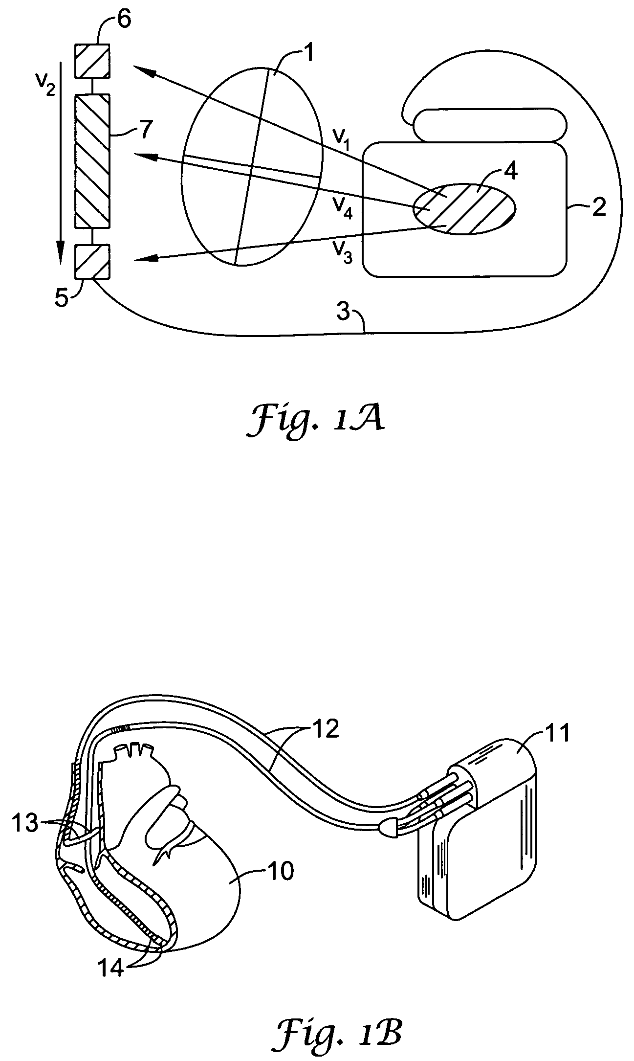 Method and devices for performing cardiac waveform appraisal