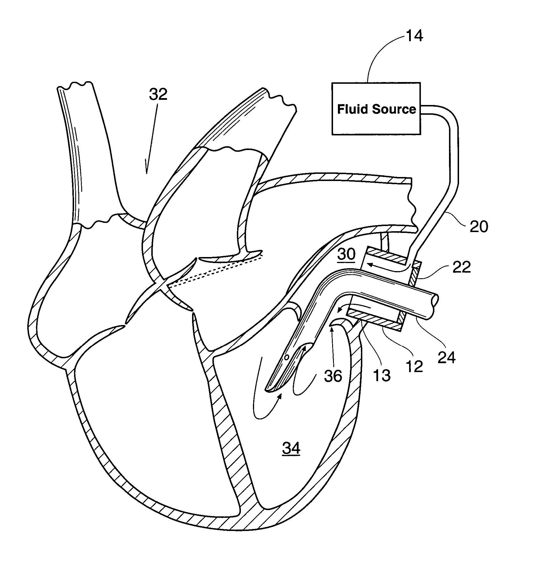 Method and apparatus for preventing air embolisms