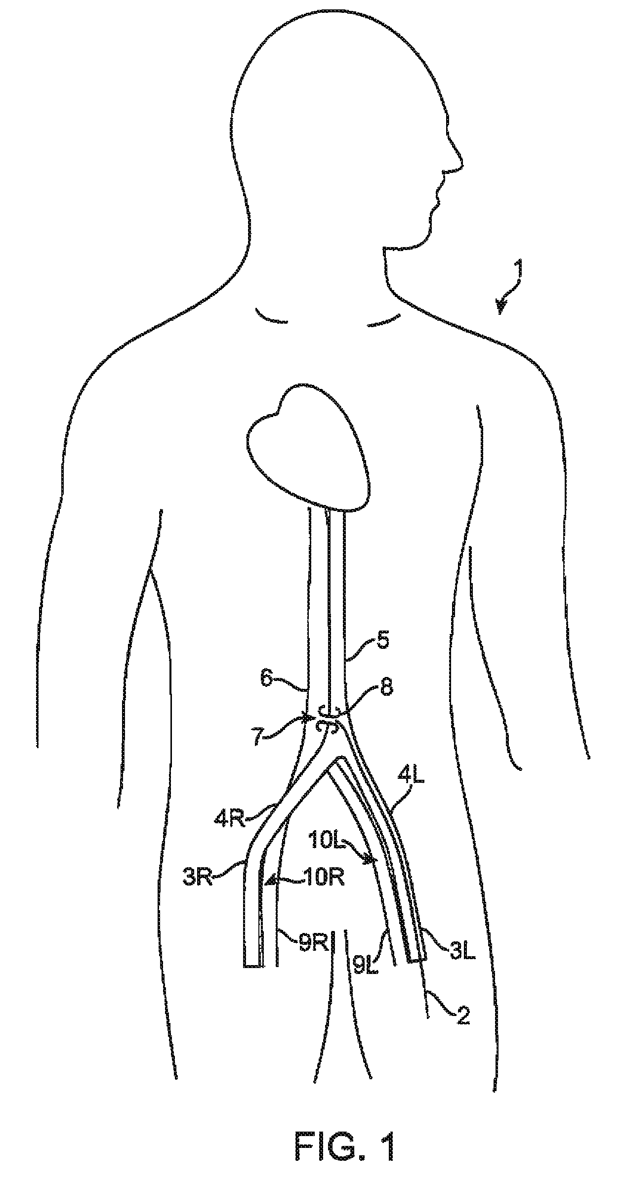 Device and method for establishing an artificial arterio-venous fistula