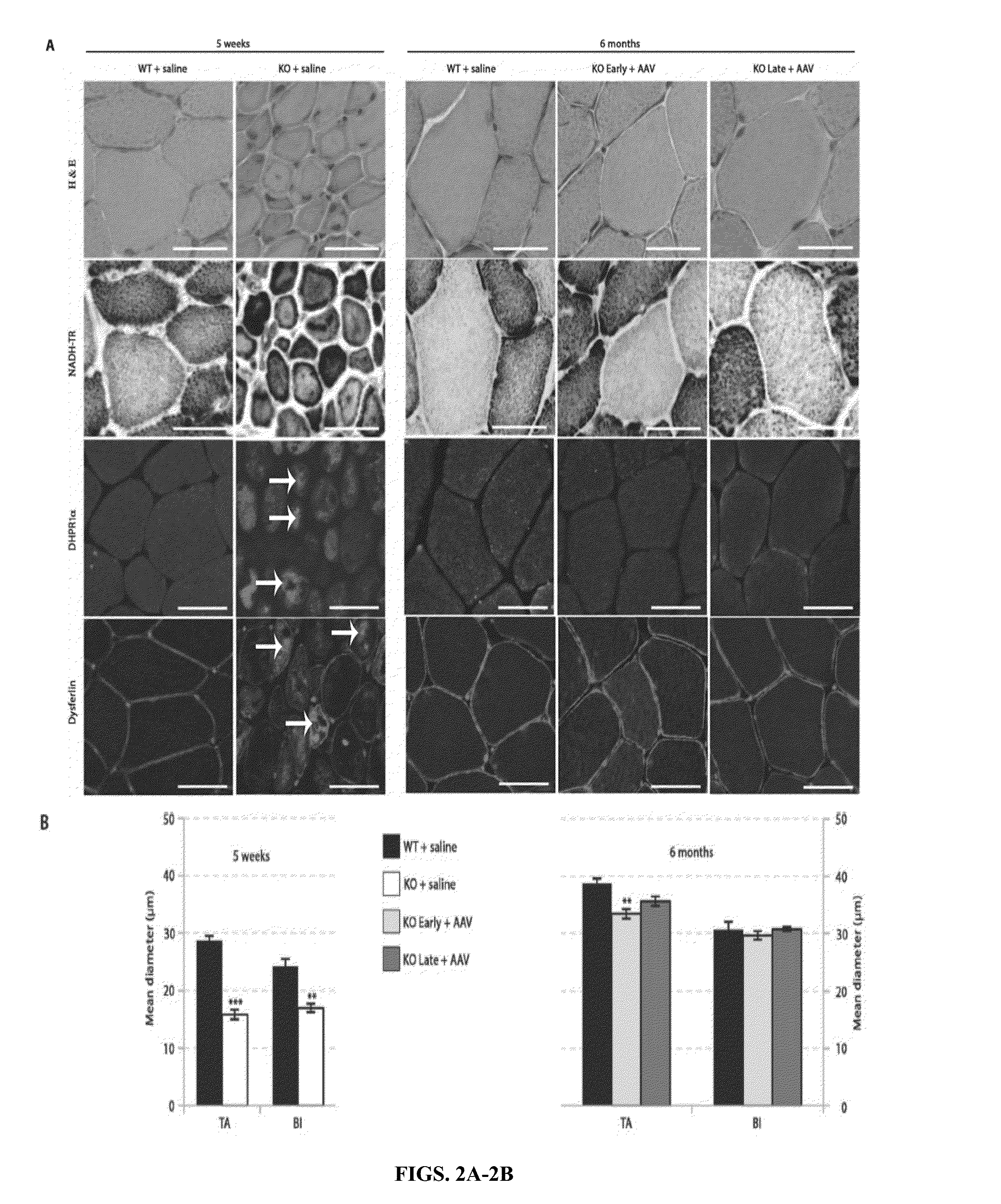 Systemic Gene Replacement Therapy for Treatment of X-Linked MyoTubular Myopathy (XLMTM)