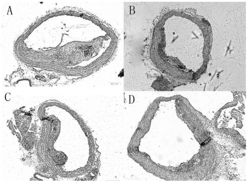 Composition for treating hyperlipidemia and atherosclerosis and application of composition