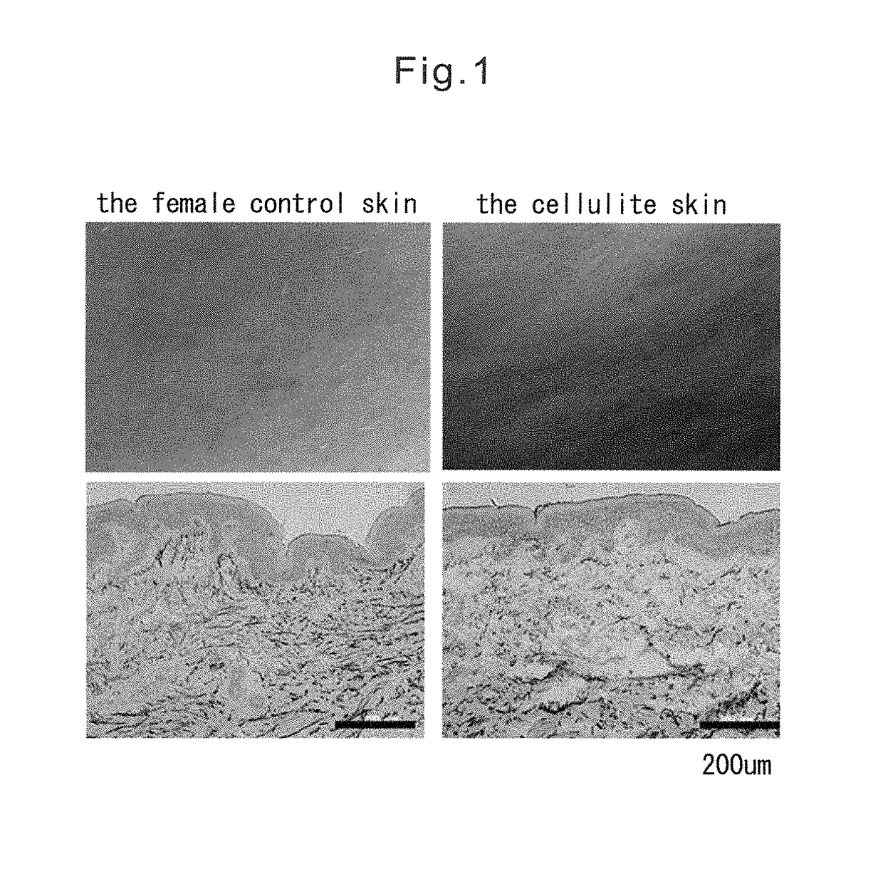 Method of evaluating cellulite and method of evaluating cellulite-effective drug using fibulin-3 and/or sarcoglycan gamma as an indicator