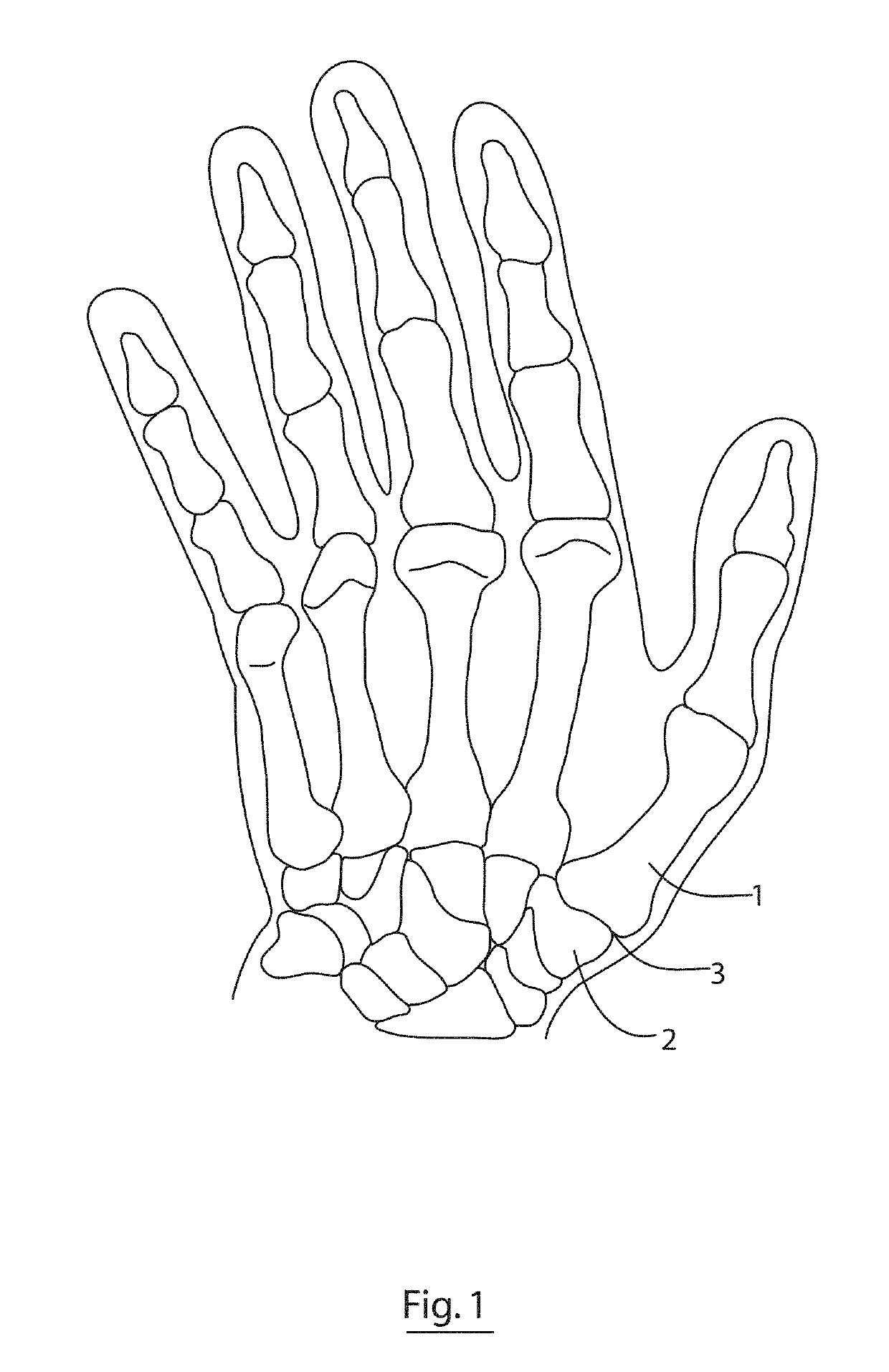 Implant for a bone joint