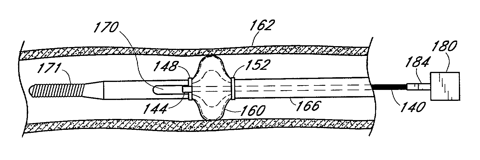 Occlusion of a vessel