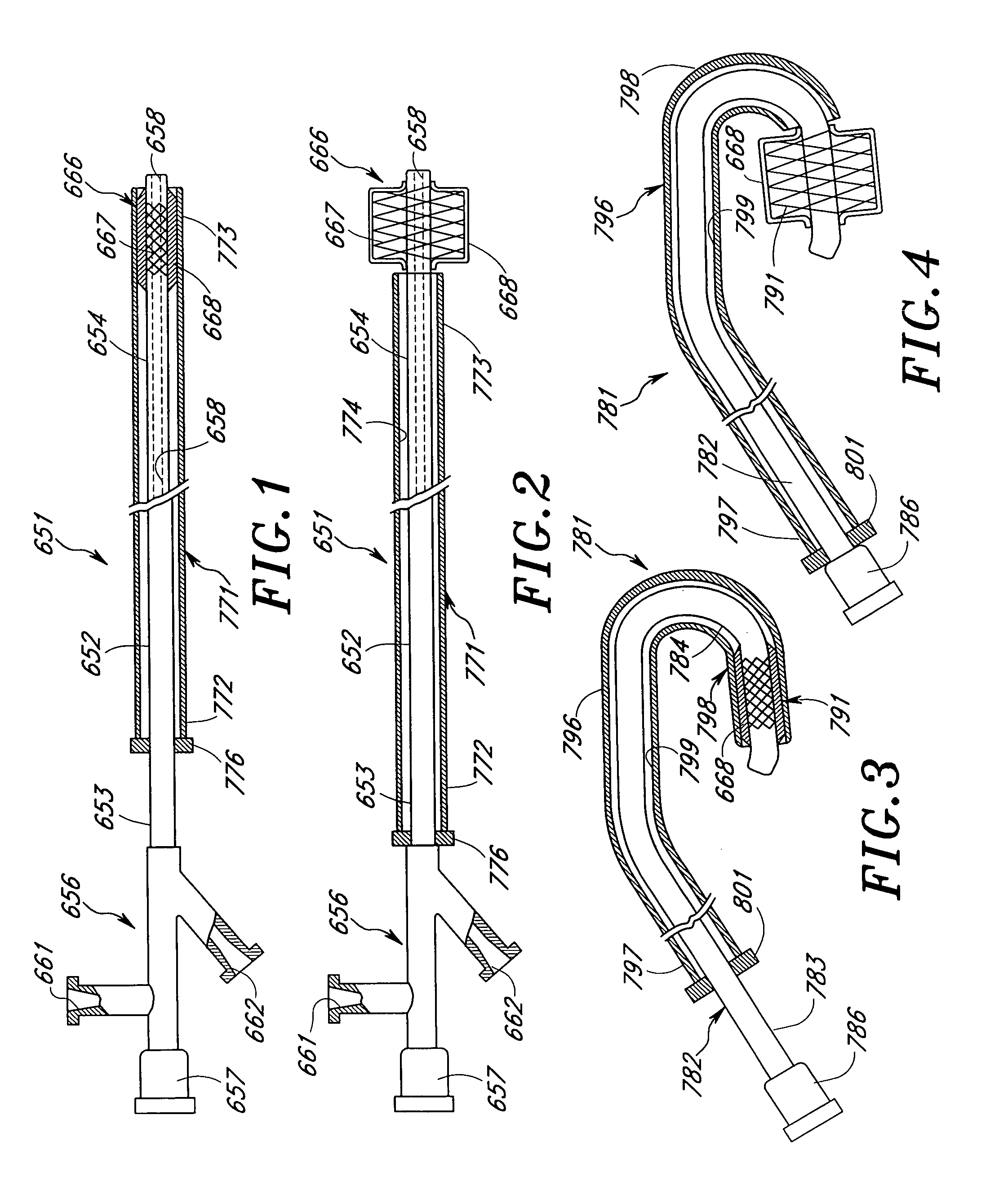 Occlusion of a vessel