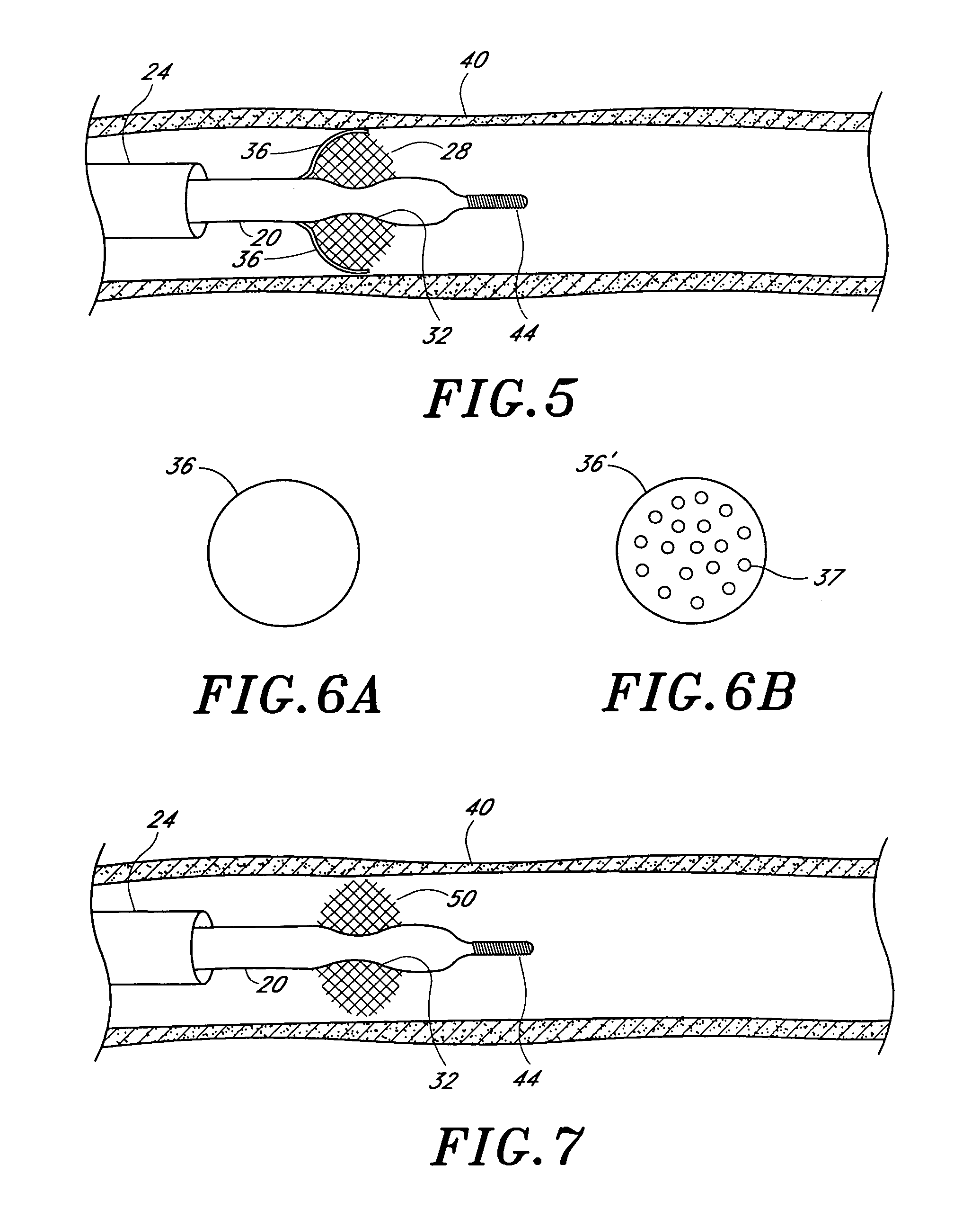 Occlusion of a vessel